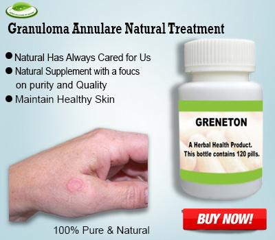 Granuloma Annulare Natural Treatment - 1